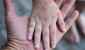 Diskes Imbau Masyarakat Terapkan PHBS Hindari Virus Cacar Monyet