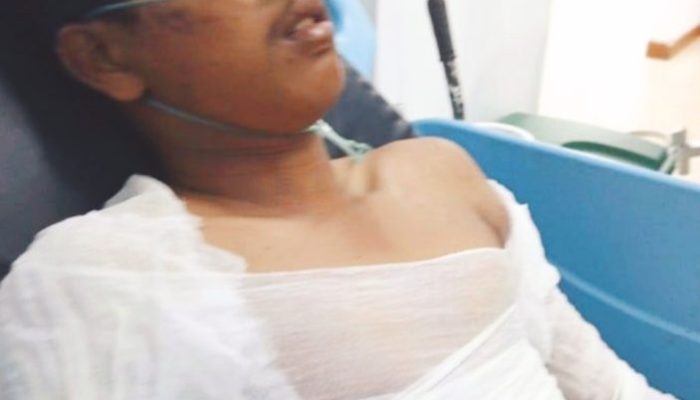 Remaja 20 Tahun Tersengat Listrik Saat Pasang Kabel Internet, Tubuh 46 Persen Luka Bakar